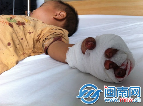 小園的左手無(wú)名指被三輪電動(dòng)車(chē)鏈條絞斷
